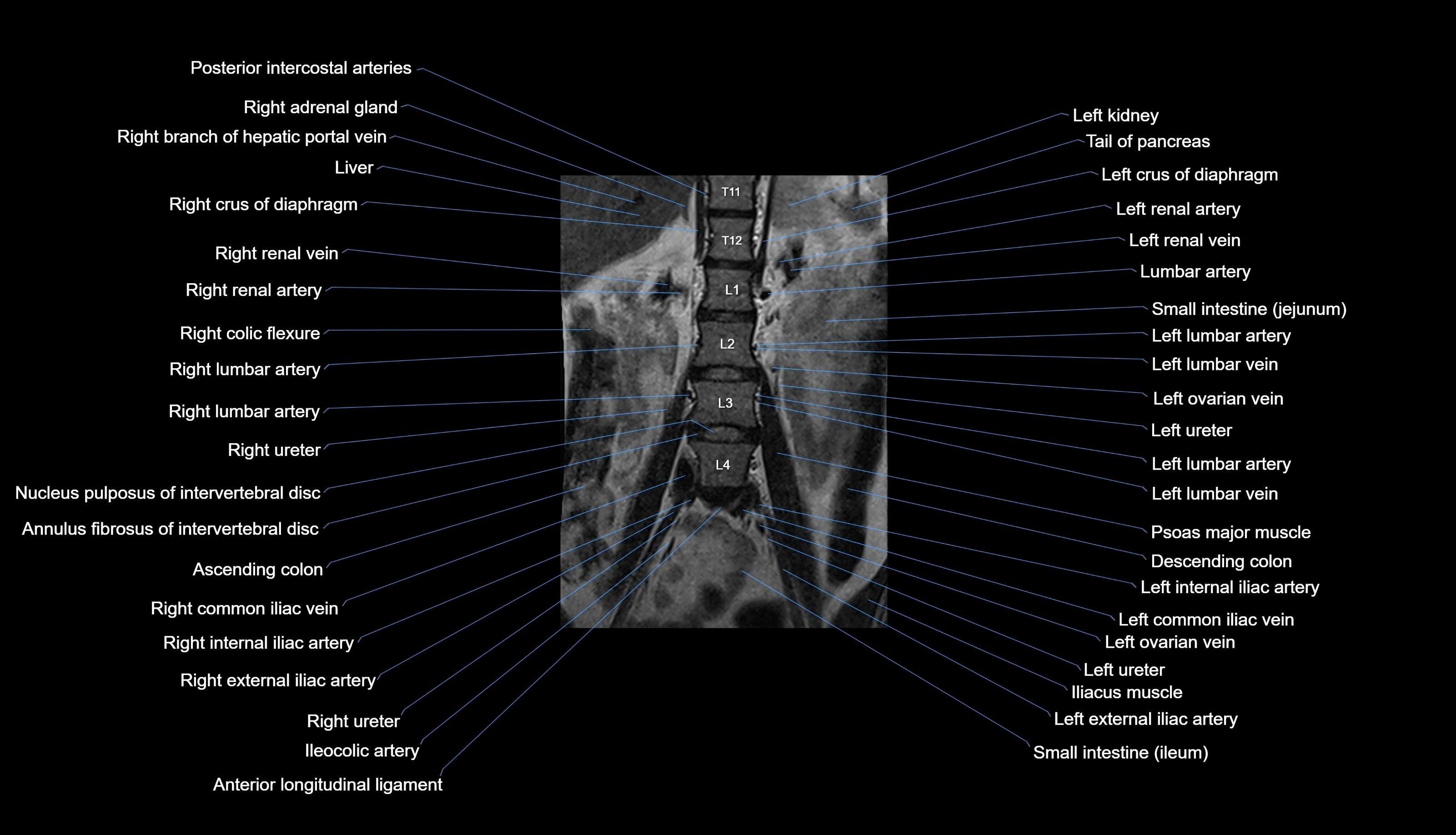MRI lumbar spine labelled coronal cross sectional anatomy 3T radiology-img-00001-00007.webp